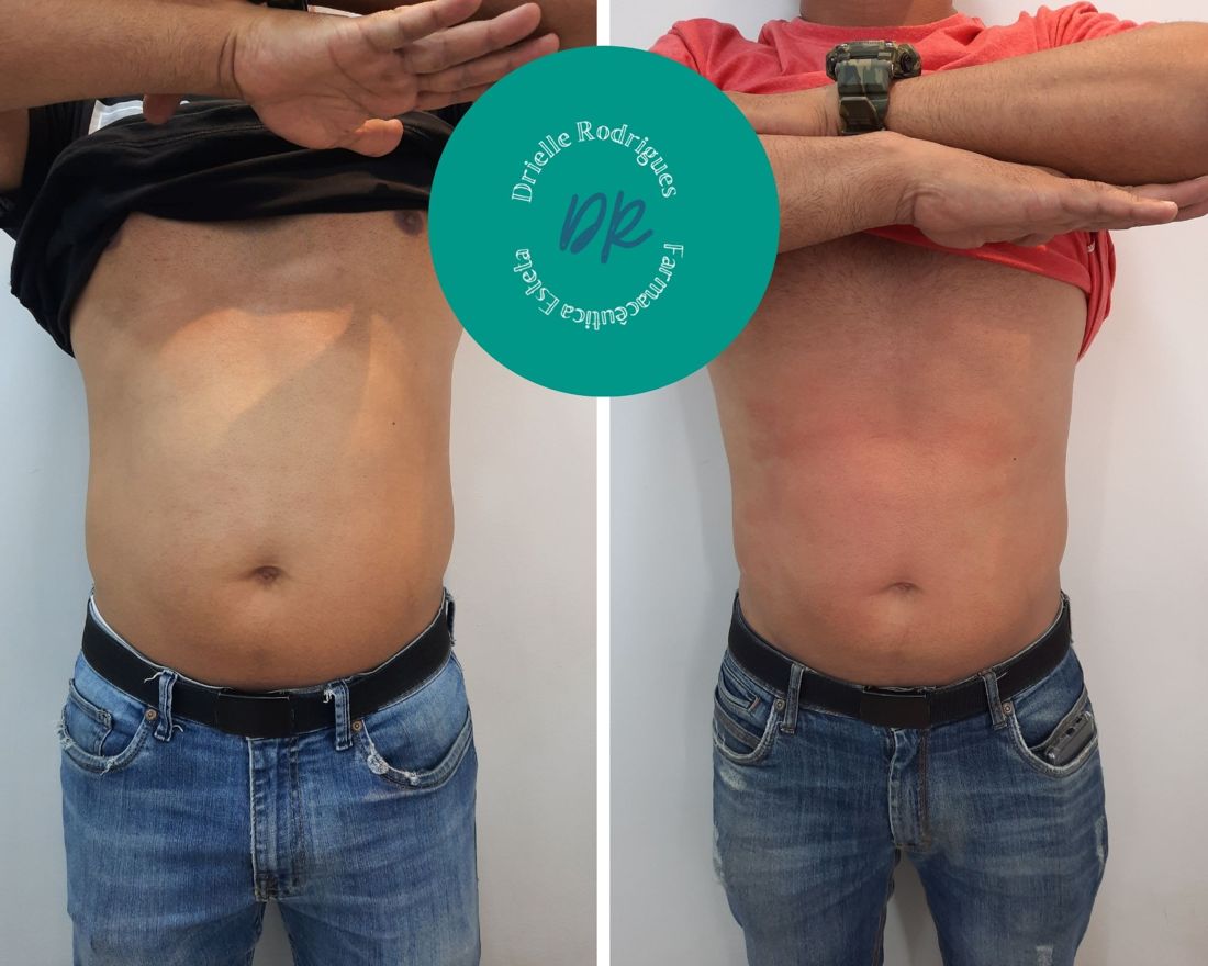 Antes e depois: Intradermoterapia nos flancos