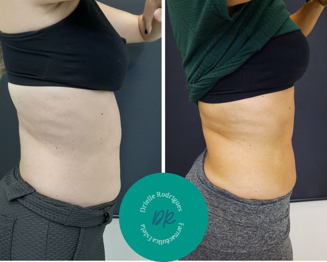 Antes e depois: Intradermoterapia no abdômen (enzimas)