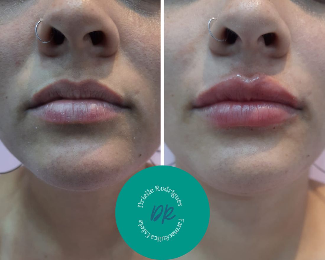 Antes e depois: Preenchimento labial