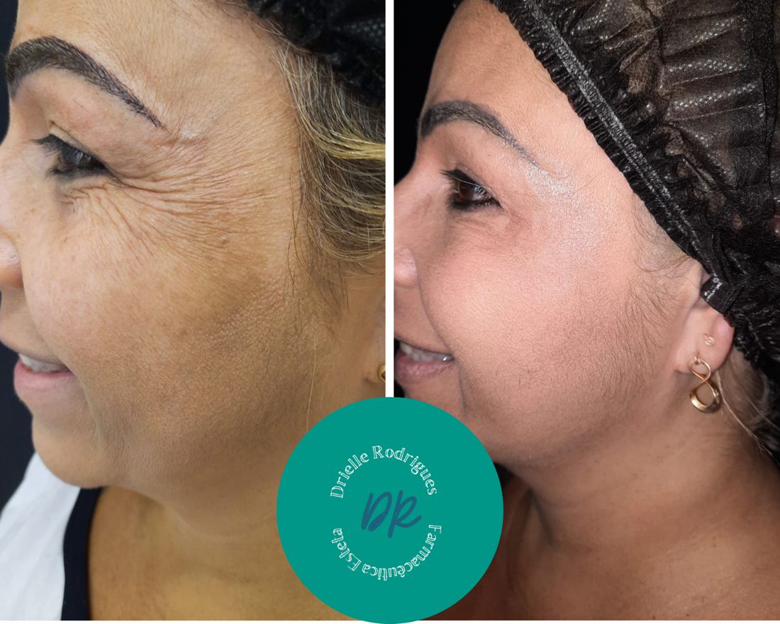 Antes e depois: Linhas de expressão tratadas com toxina botulínica (Botox)