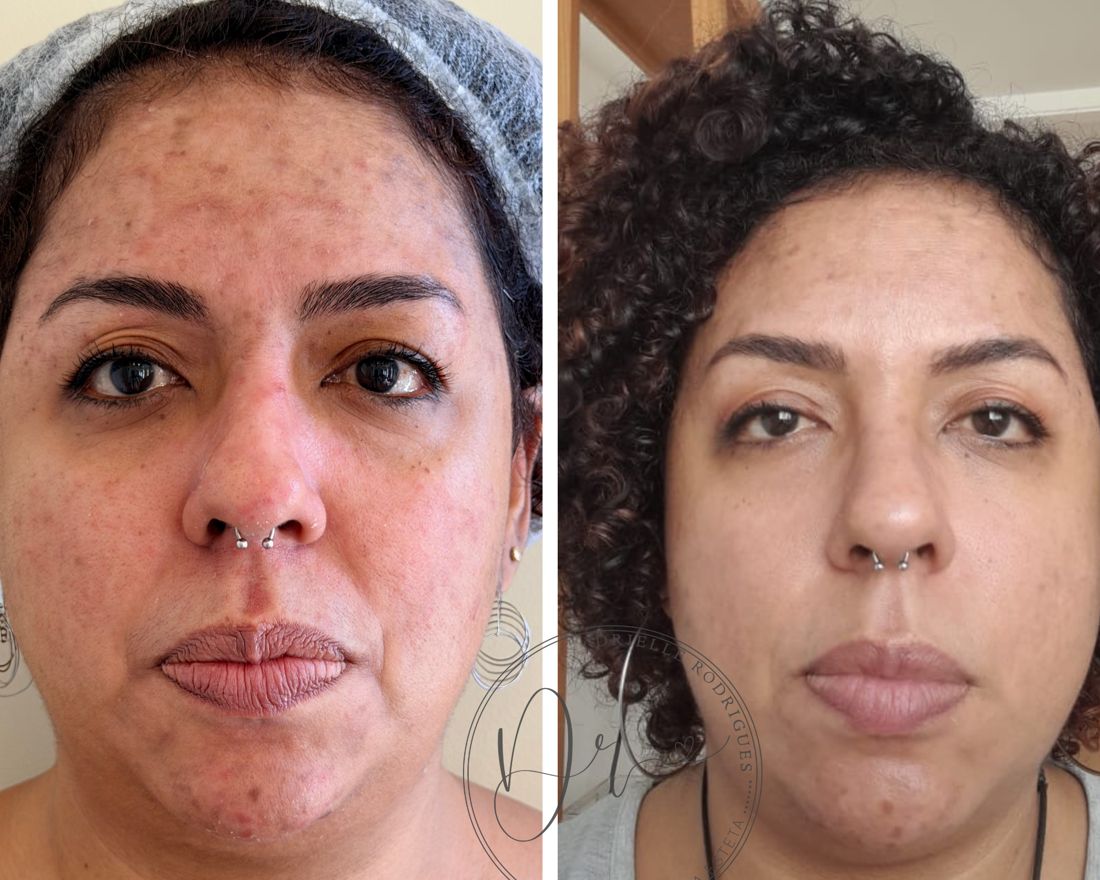 Antes e depois: Gerenciamento de pele