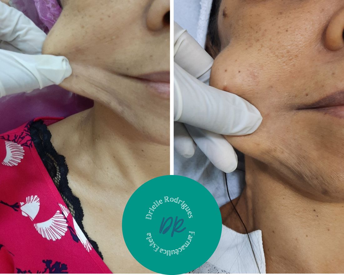 Antes e depois: Bioestimulador de colágeno facial