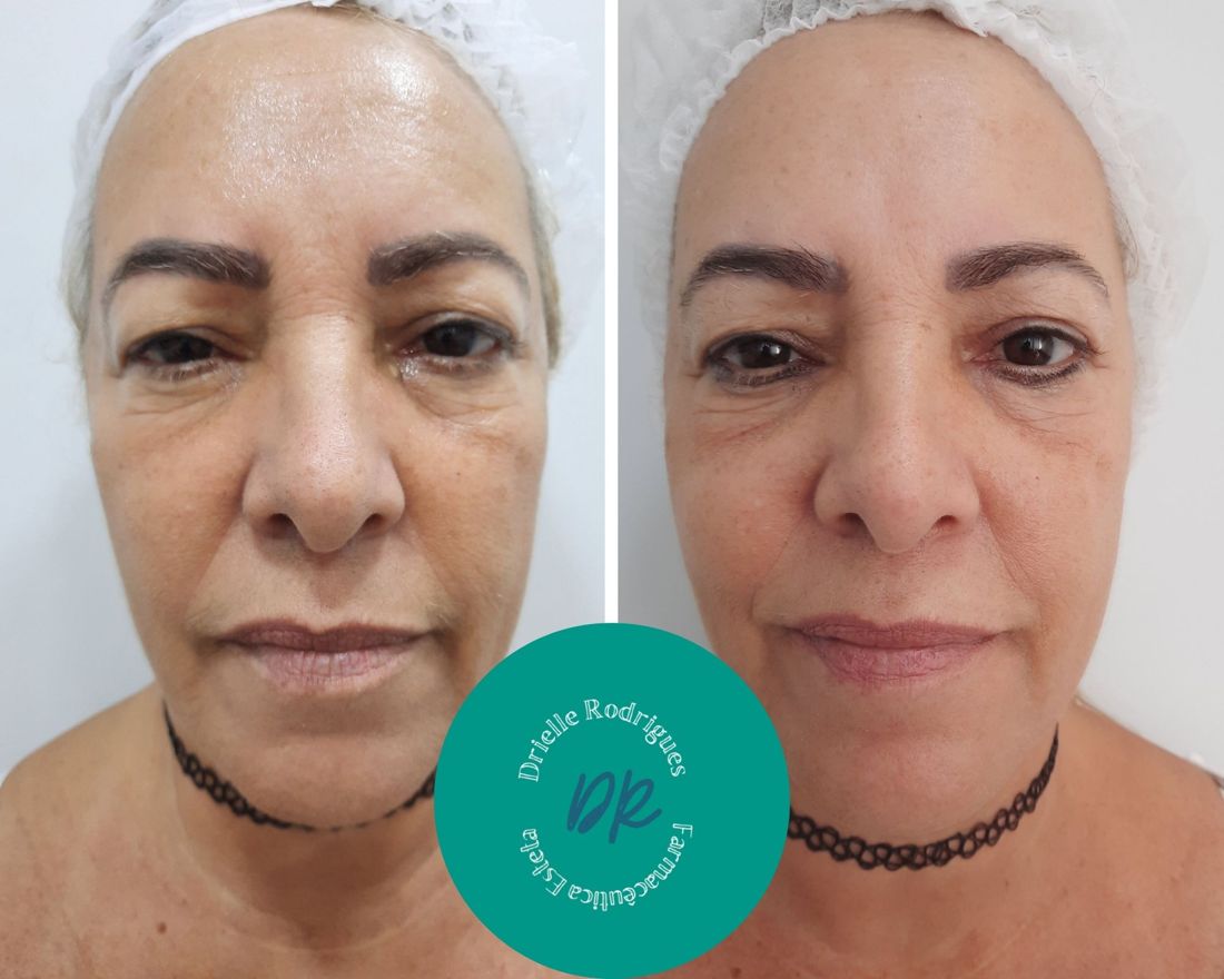 Antes e depois: Toxina botulínica